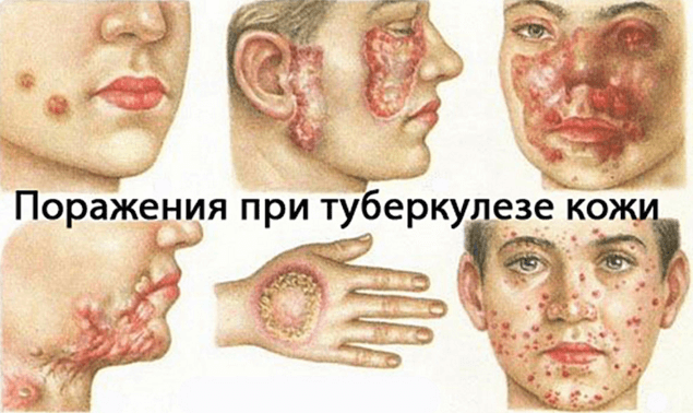 Признаки туберкулеза кожи: симптомы