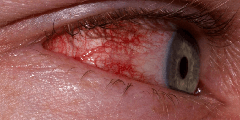 Воспалительный процесс в глазу