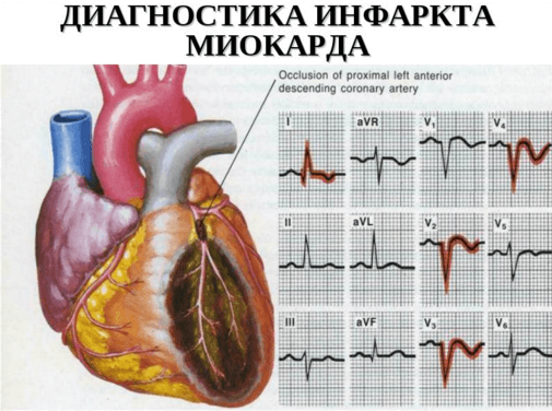 Диагностика инфаркта миокарда