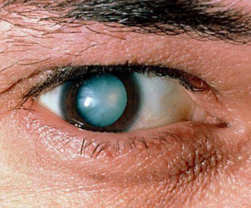 Симптомы катаракты глаза