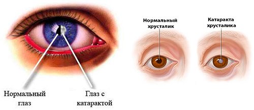 Что представляет собой катаракта?