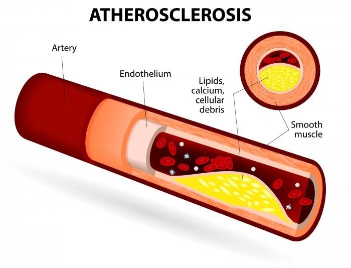 Атеросклероз: симптомы, лечение народными средствами