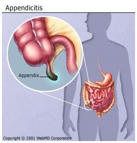 Аппендицит: причины, симптомы и лечениe