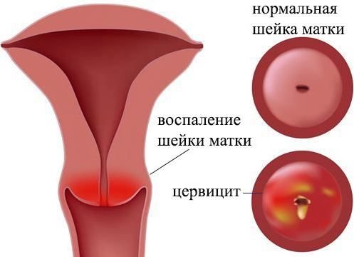 Симптомы воспаления шейки матки