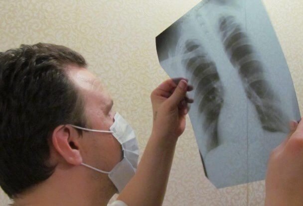 Лечение туберкулеза
