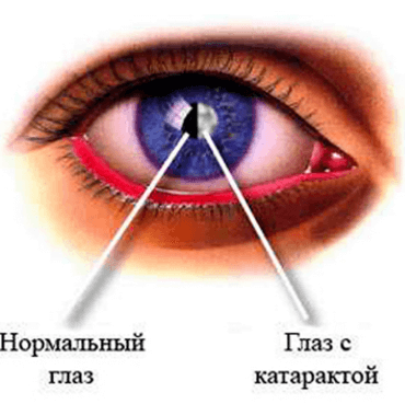 Стадии катаракты глаза