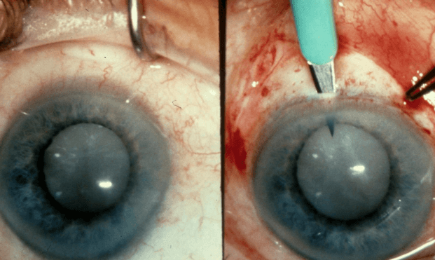 Экстракция катаракты туннельным экстракапсулярным методом