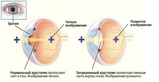 Начальная стадия катаракты: как появляется