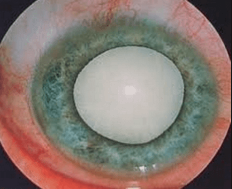 Поздний этап развития катаракты