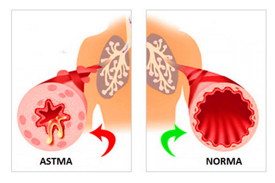 Формы бронхиальной астмы