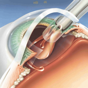 Операция по удалению катаракты глаза
