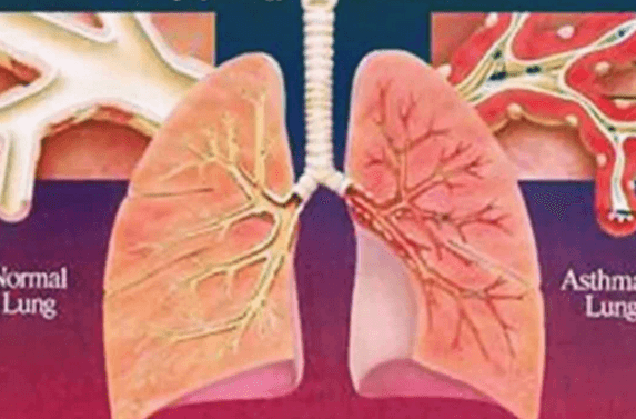 Легкая форма бронхиальной астмы
