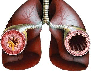 Смешанная бронхиальная астма