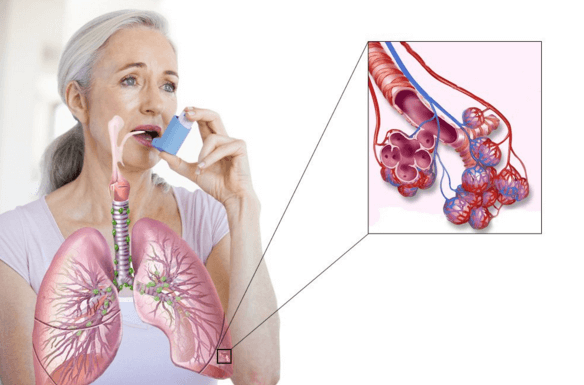 Симптомы бронхиальной астмы