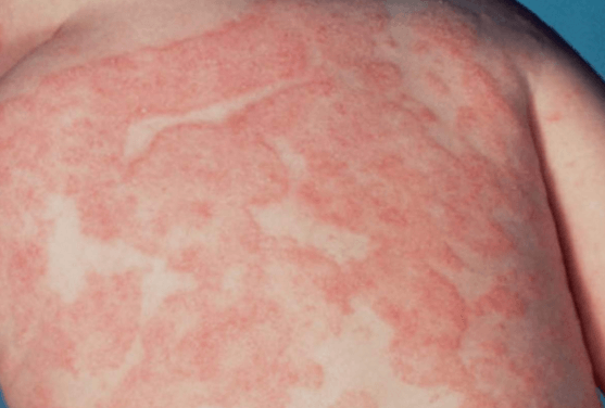 Атопический дерматит – кожная реакция на аллерген