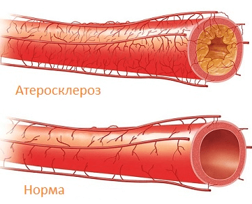 Атеросклероз 