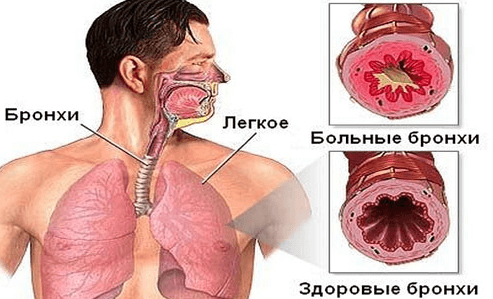 Период обострения бронхиальной астмы