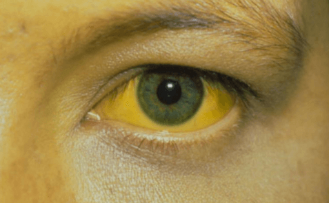Желтушность белков глаз и кожи