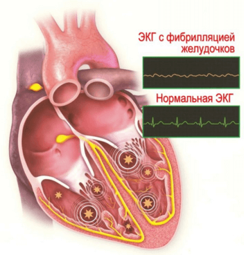 Желудочковая аритмия сердца