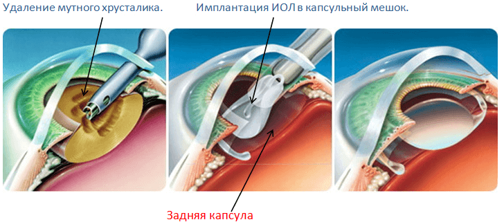 Лазерная дисцизия – метод удаления вторичной катаракты