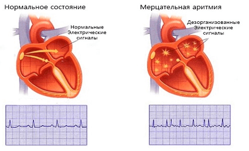 Формы сердечных аритмий
