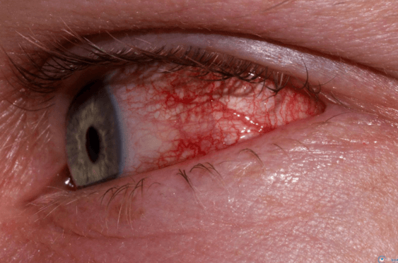 Воспалительные процессы внутри глаза