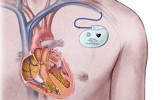 Вживление кардиостимулятора под кожу