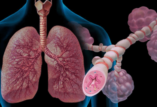 Терапия бронхиальной астмы