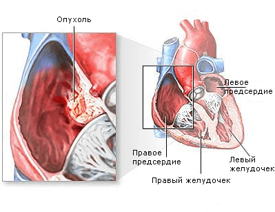 Опухоль сердца