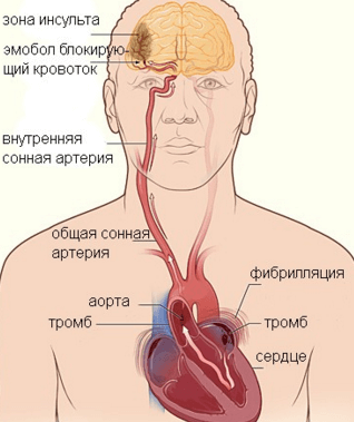 Лечение мерцательной аритмии