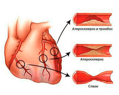 Функциональные классы (ФК) стенокардии напряжения