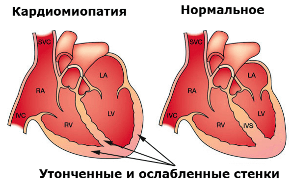 Кардиомиопатия – изменение структуры сердечной мышцы