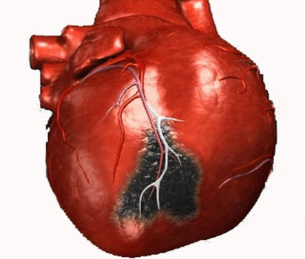 Обширный инфаркт миокарда