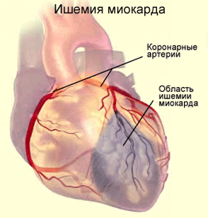 Типичная форма инфаркта миокарда