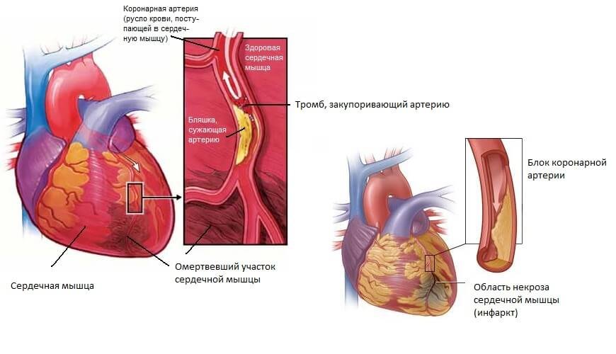 Трансмуральный инфаркт миокарда - что это такое и как лечить?
