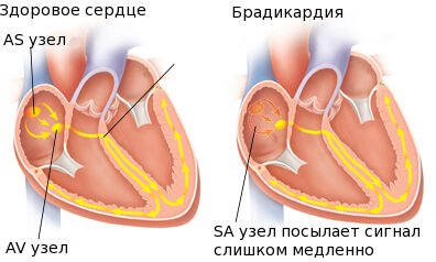 Особые состояния больного при аритмии Особые состояния больного при аритмии