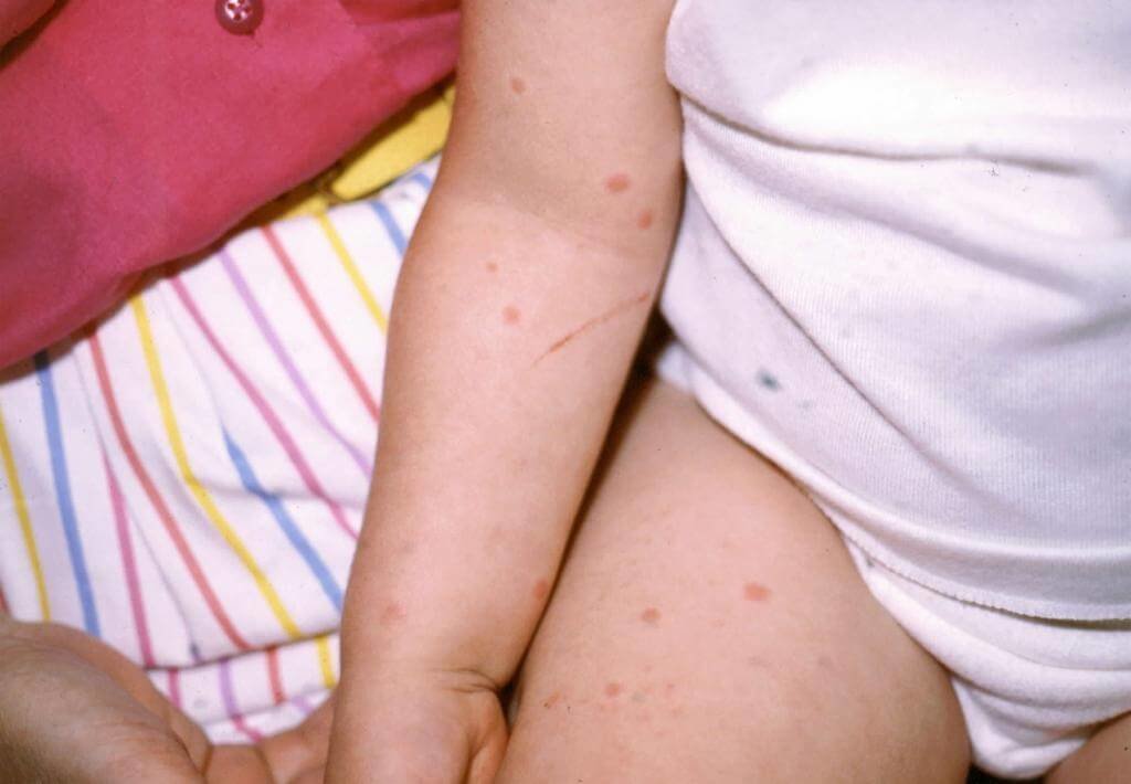 Симптомы крапивницы у детей