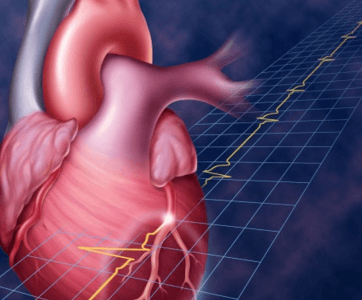 Инфаркт миокарда: симптомы