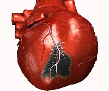 Острый инфаркт миокарда