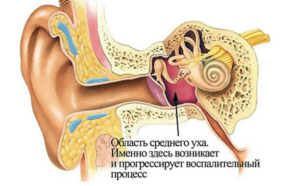 Воспаление во внутреннем ухе