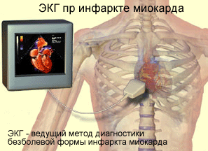 Диагностика атипичных форм инфаркта миокарда