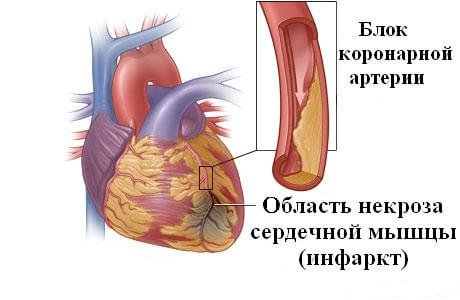 Осложнения острого периода инфаркта миокарда