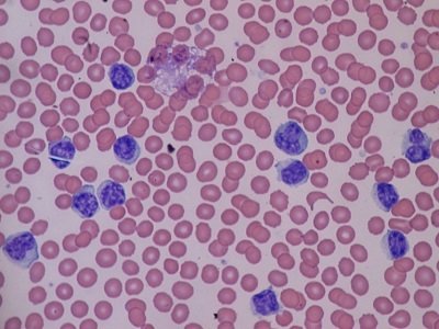 Повышенные лимфоциты в крови у ребенка